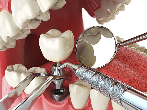 Best Emergency Root Canal Treatment in Coopersville, MI